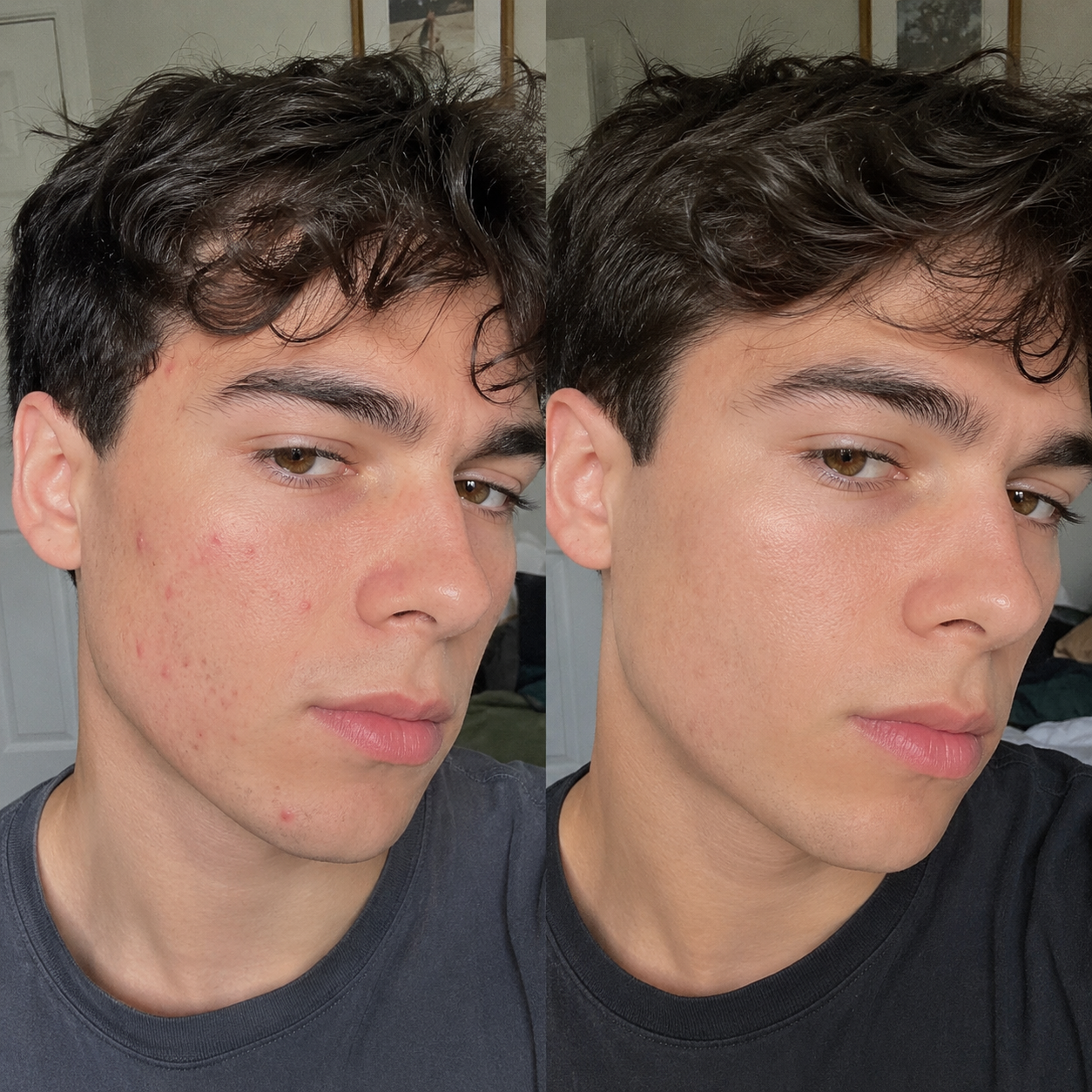 Before & After: Blemishes